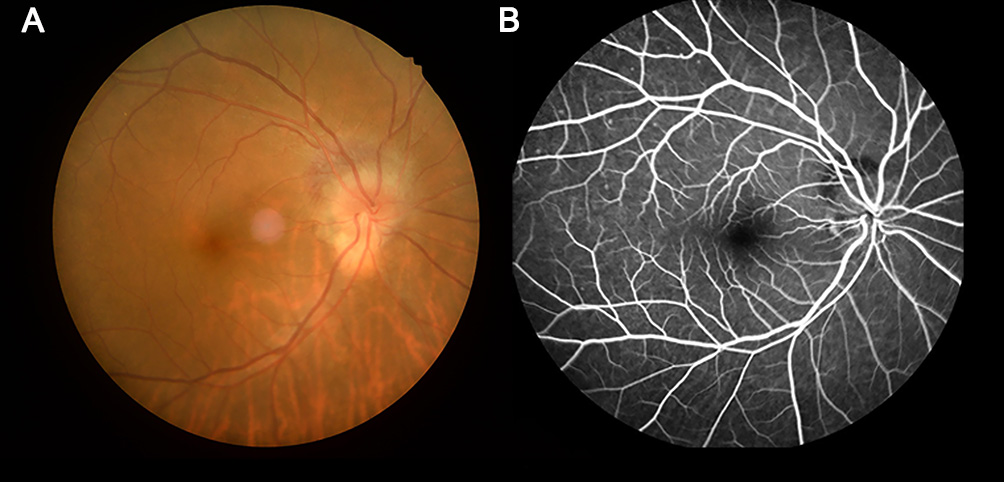 Altered spontaneous brain activity patterns in dysthyroid optic ...