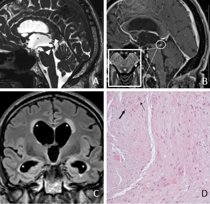 Magnetic resonance imaging of pilocytic astrocytomas in adults with ...