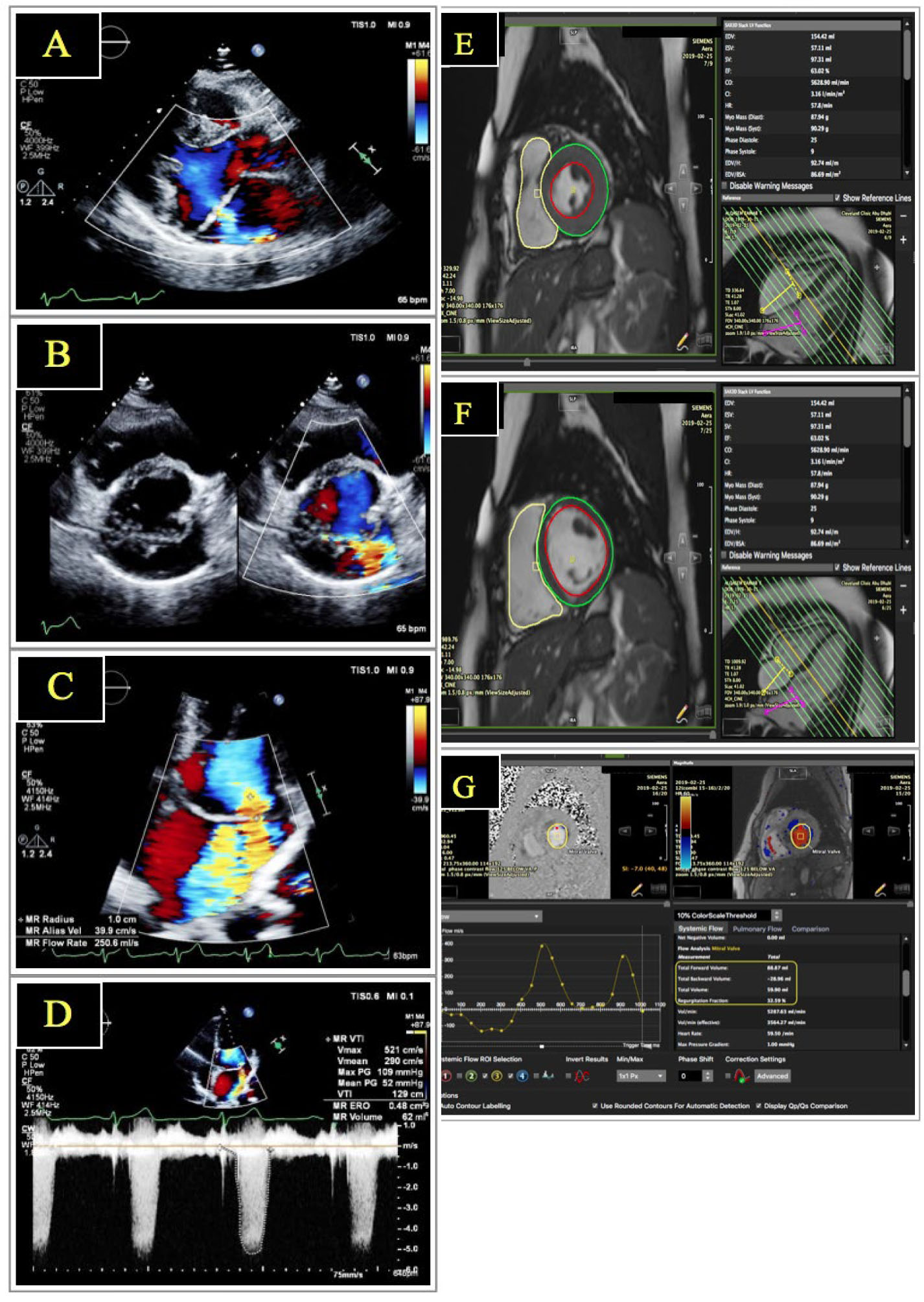 Quantification of mitral regurgitation using transthoracic ...