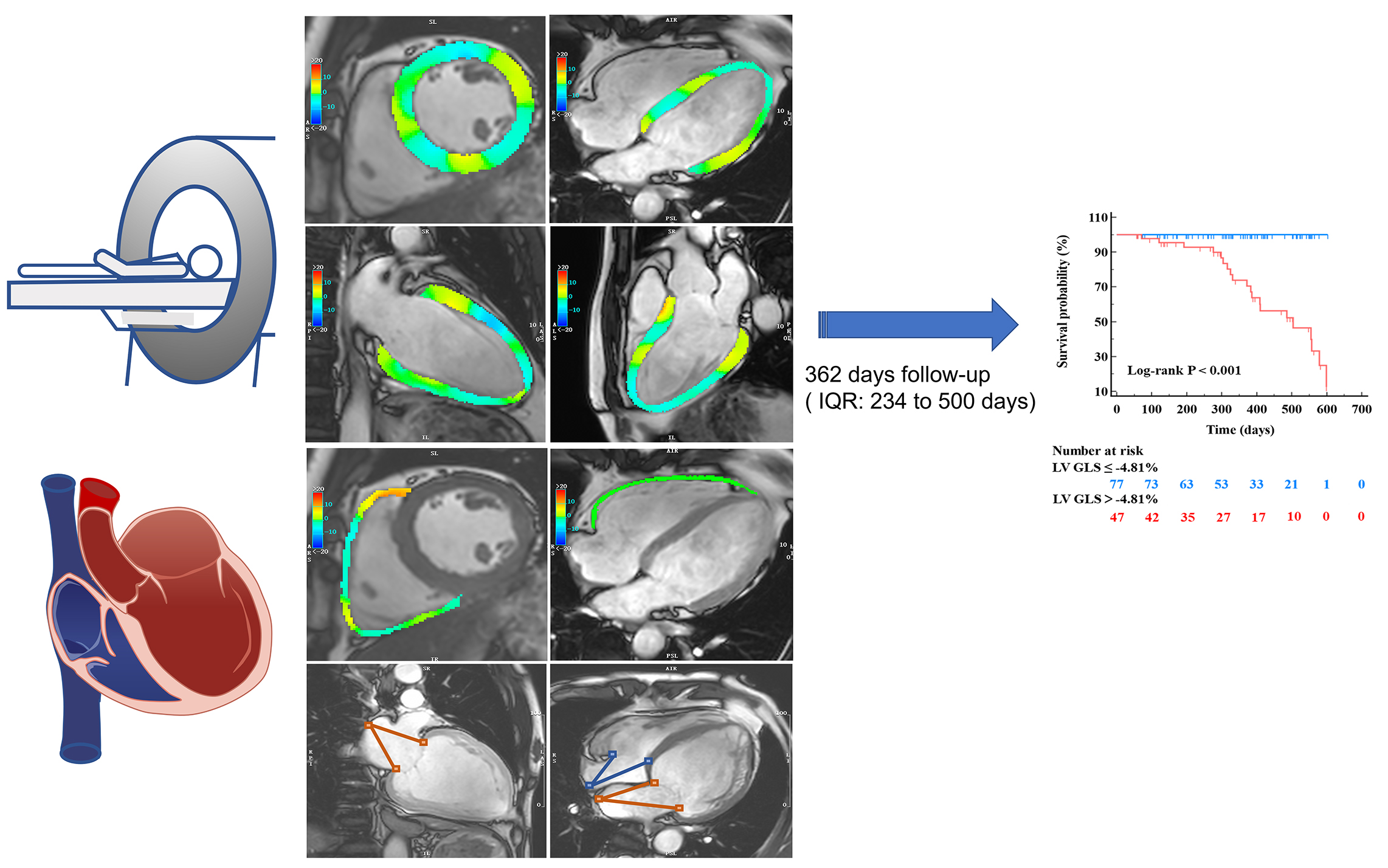 Prognostic Significance of Biventricular and Biatrial Strain in Dilated ...