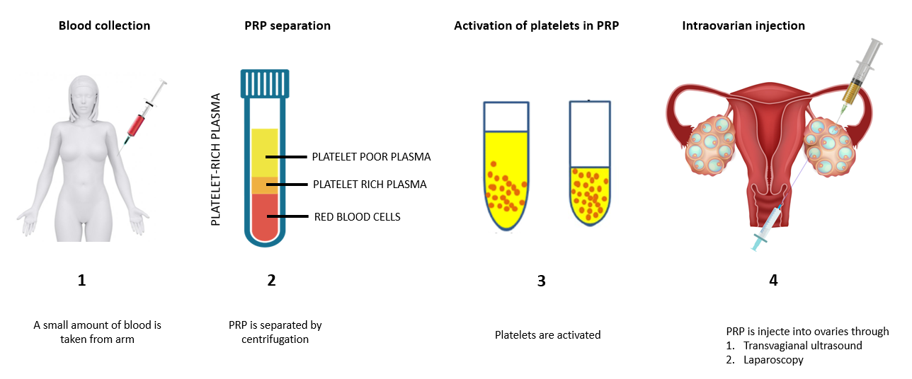 Administration of autologous platelet rich plasma and the impact on ...