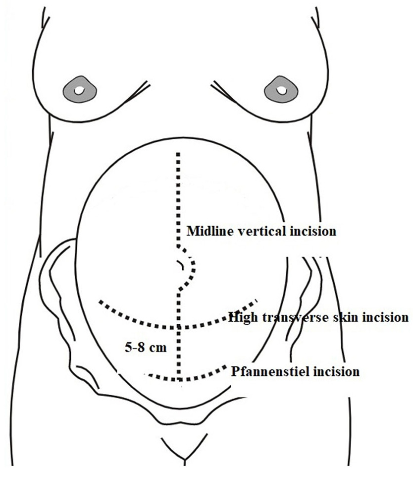 Can high transverse skin incision (Modified Maylard) be a new ...
