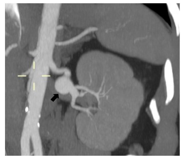 Successful endovascular management of renal artery aneurysm containing ...