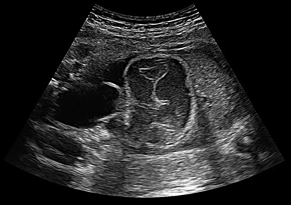 Fetal primary volvulus with abnormal heart rate patterns on ...