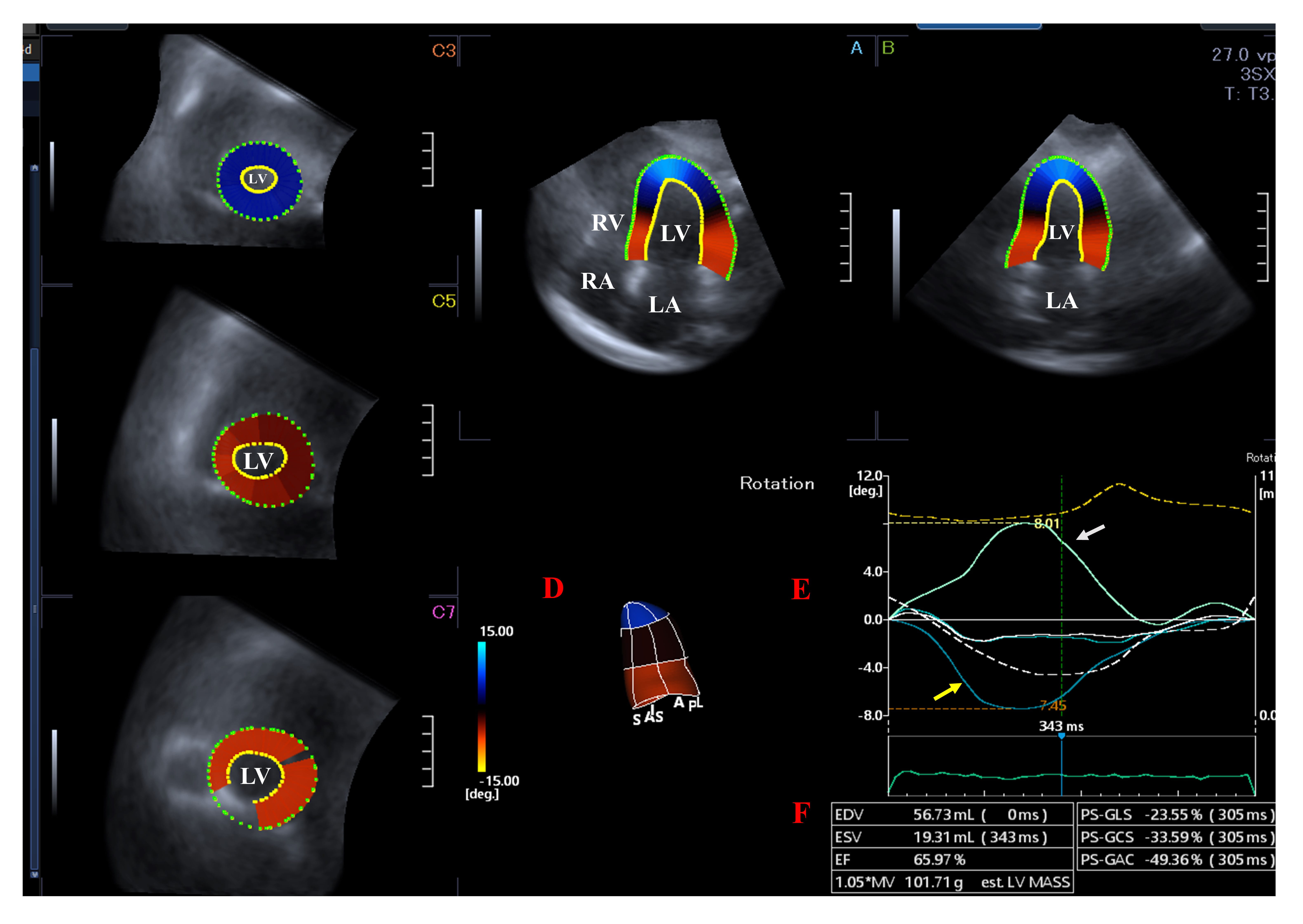 Prevalence of left ventricular ‘rigid body rotation’, the near absence ...
