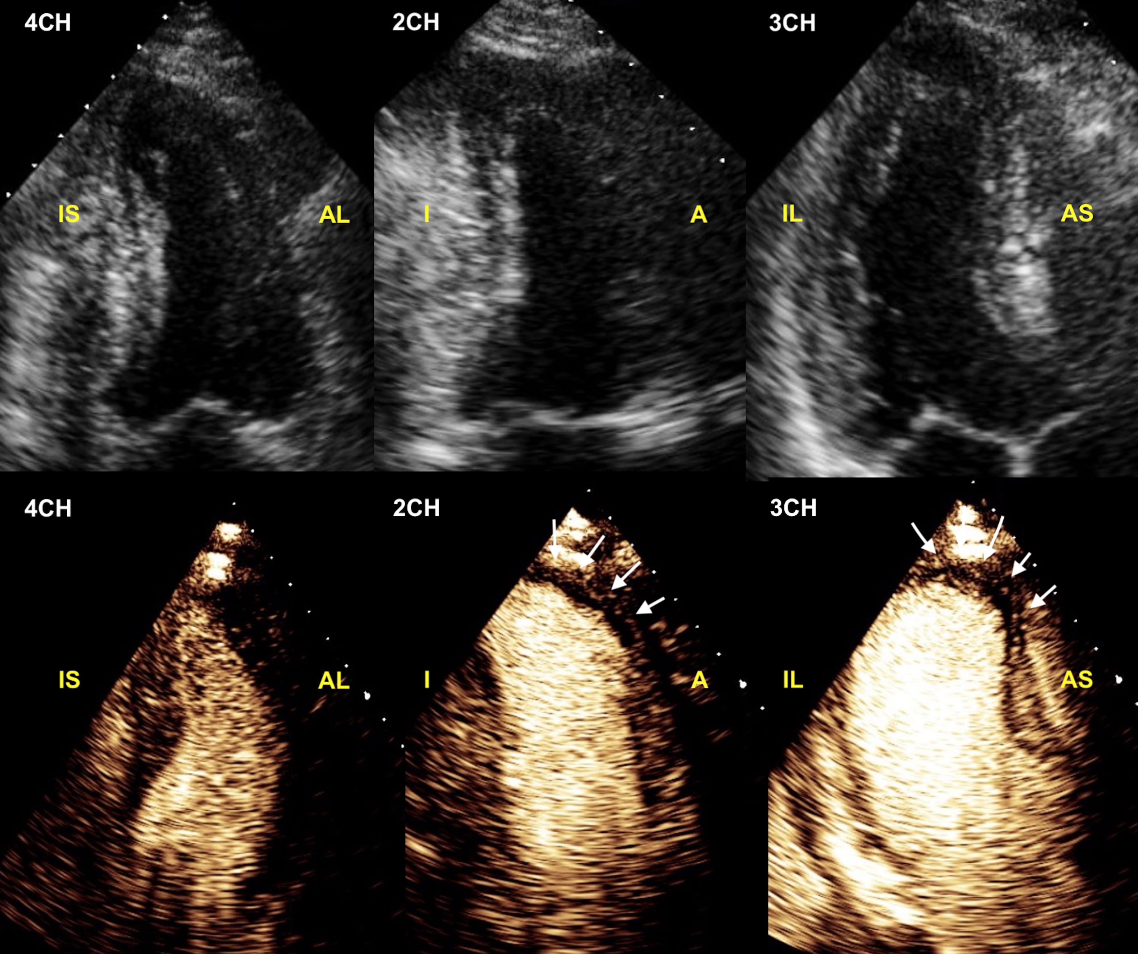 Rest contrast echocardiography unmasks hidden wall motion abnormalities ...