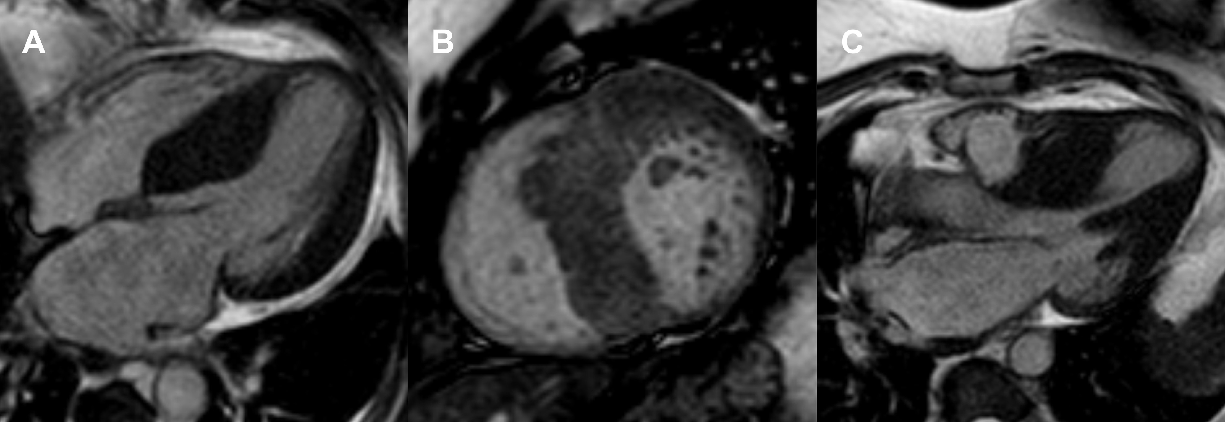 Role of Cardiac Magnetic Resonance in the Diagnosis of Infiltrative ...