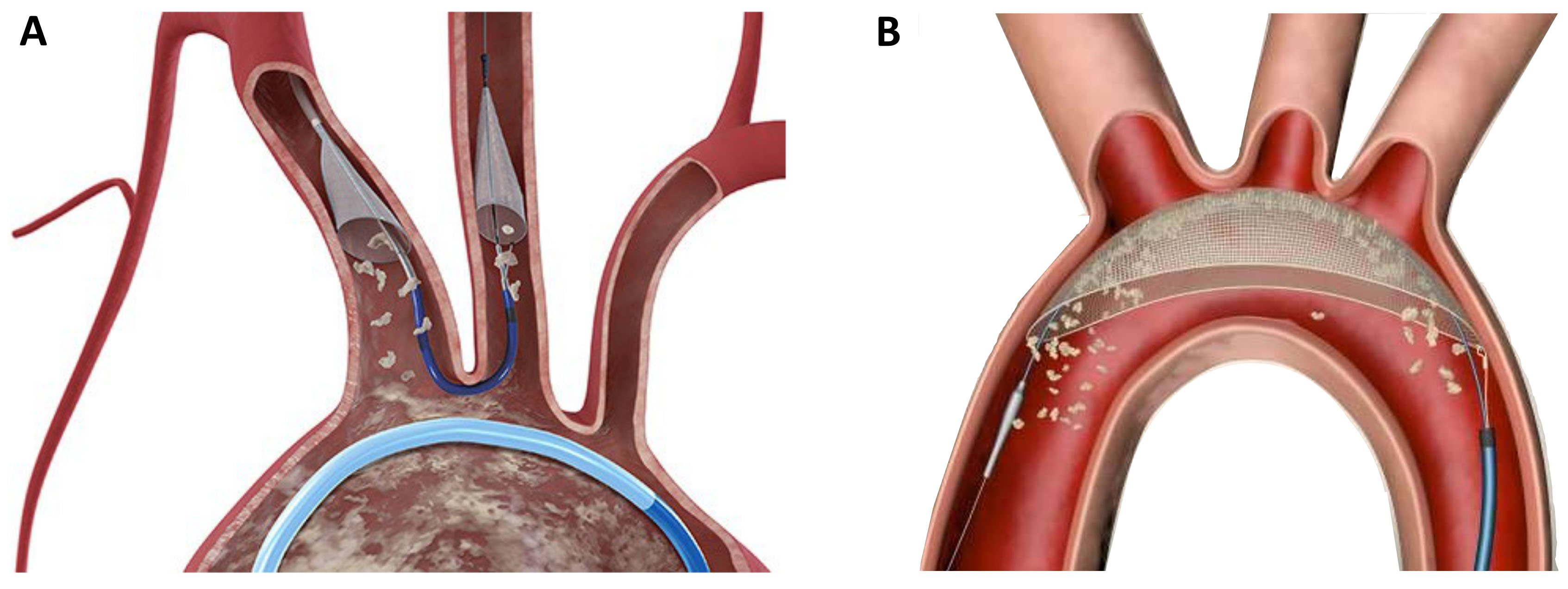 Sentinel Tavr Current Prostheses for Transcatheter Heart Valve Replacement: A ...